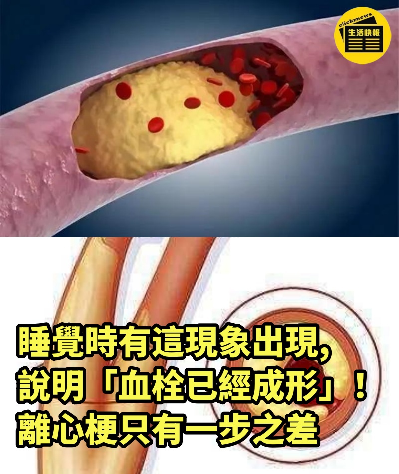 睡覺時有這現象出現，說明「血栓已經成形」！離心梗只有一步之差